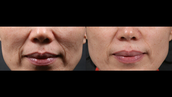 Female face, before and after Potenza Microneedling Treatment, front view, patient 3