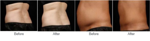 Patient’s body, before and after SculpSure treatments, oblique view