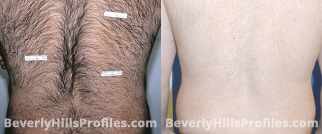 Male back, before and after Laser Hair Removal treatment