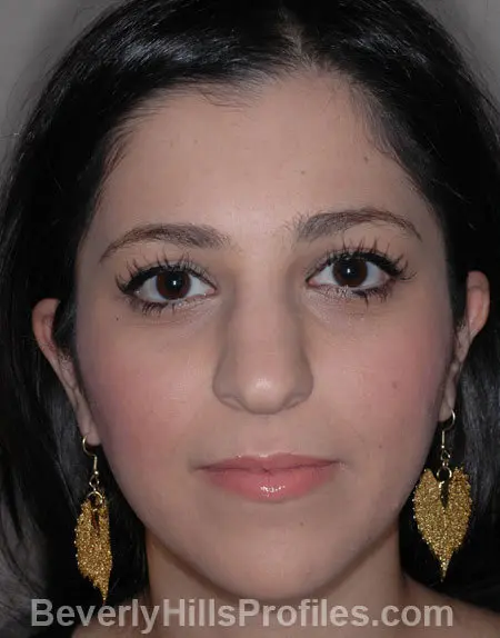 Woman’s face, before Ethnic Rhinoplasty treatment, front view, patient 4