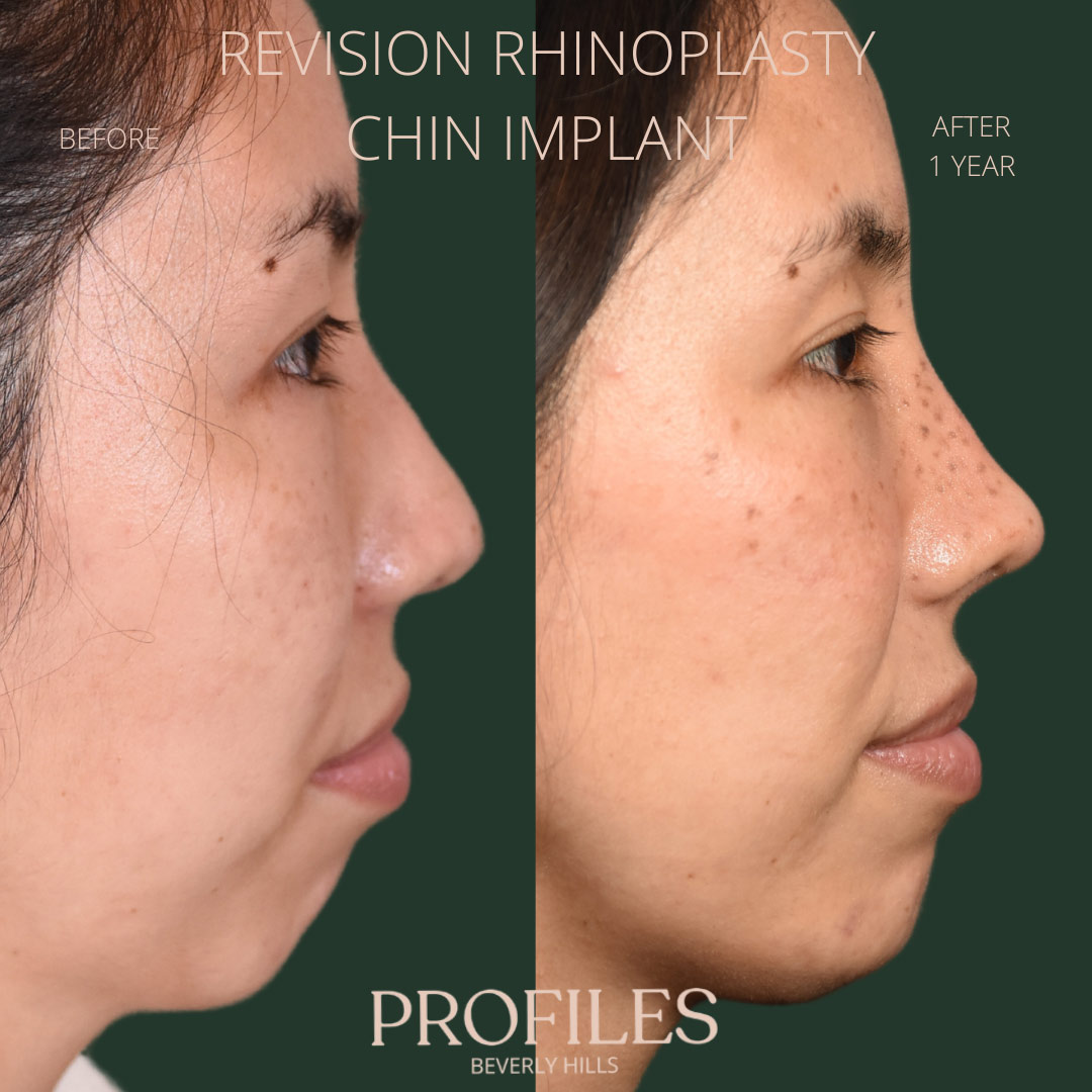 Female face, before and after Revision Rhinoplasty treatment, r-side view, patient 4