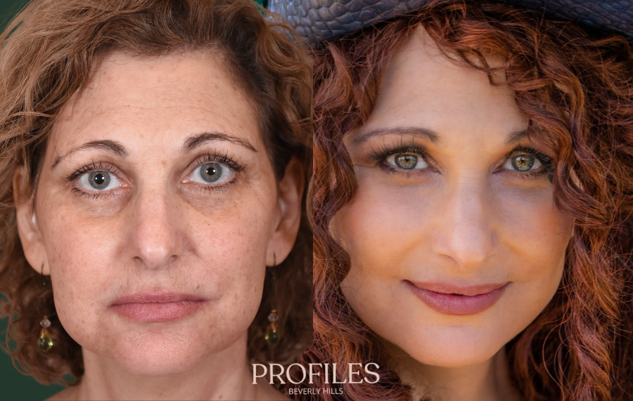 Woman’s face, before and after Hybrid Facelift treatment, front view