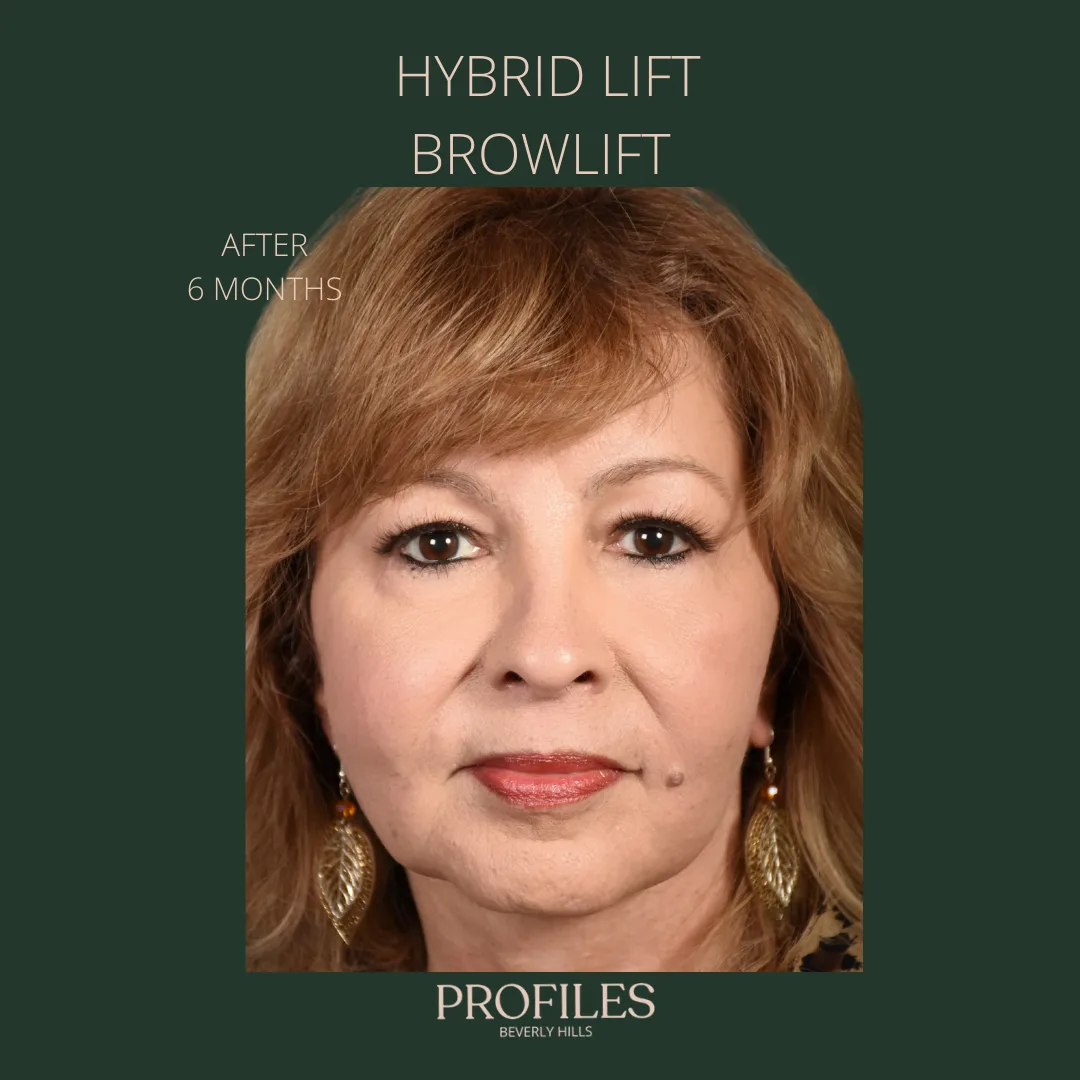 Hybrid lift brow lift photo